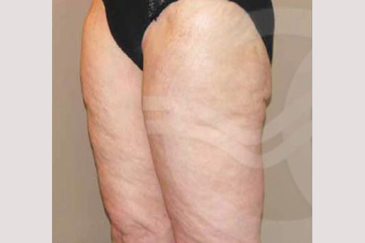 Thigh Lift Inner Crural Lift ante/post-op III