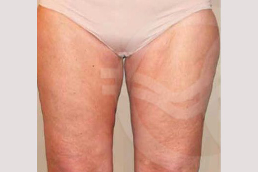 Thigh Lift and Liposculpture ante/post-op I