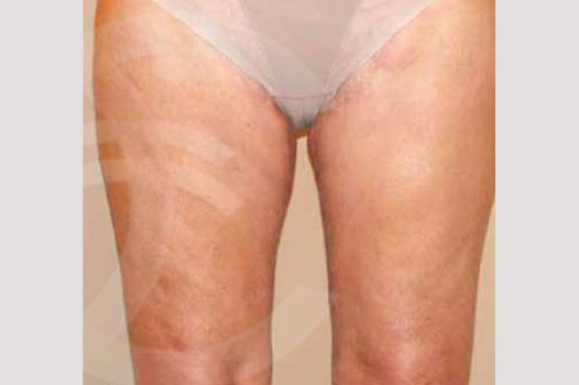 Thigh Lift and Liposculpture ante/post-op I