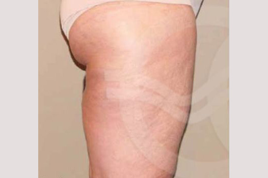 Thigh Lift and Liposculpture ante-op lateral