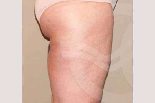 Thigh Lift and Liposculpture ante/post-op II