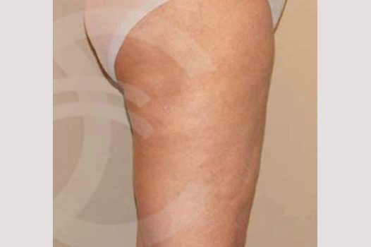 Thigh Lift and Liposculpture post-op lateral