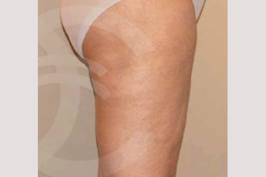 Thigh Lift and Liposculpture ante/post-op II