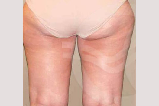 Thigh Lift and Liposculpture ante-op retro/lateral