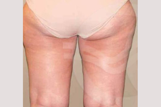 Photos Thigh Lift  ante/post-op III
