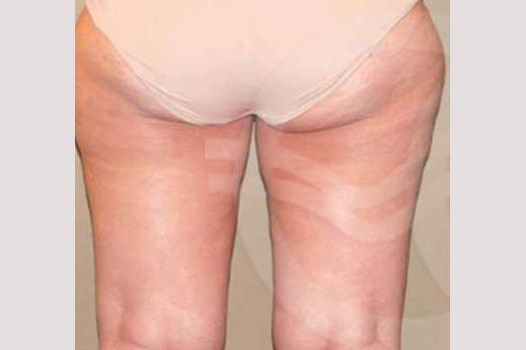 Thigh Lift and Liposculpture ante/post-op III