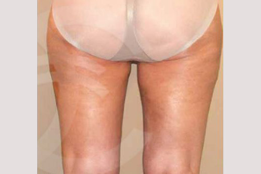 Thigh Lift and Liposculpture post-op retro/lateral