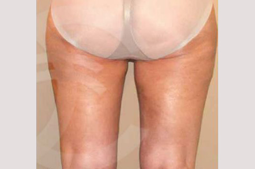 Thigh Lift and Liposculpture ante/post-op III