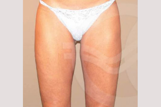 Photos Thigh Lift  ante/post-op I