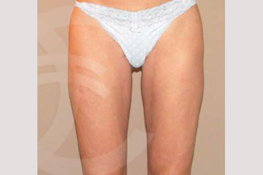 Photos Thigh Lift  ante/post-op I