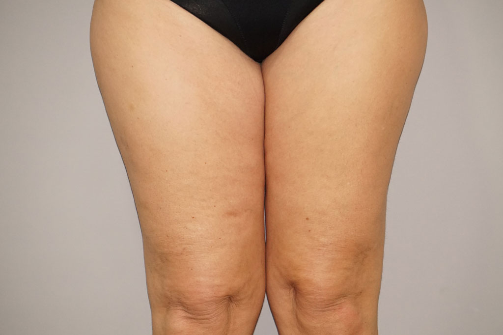 Thigh Lift  ante/post-op I