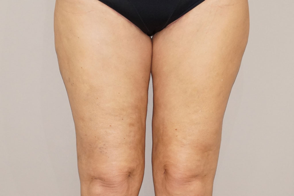 Thigh Lift  ante/post-op I