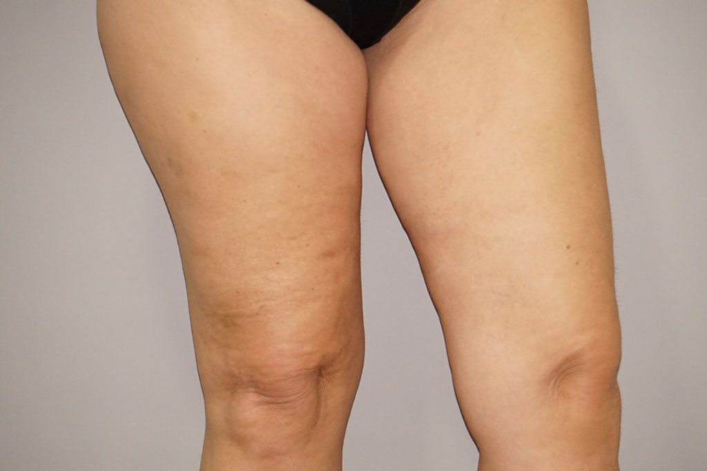 Thigh Lift  ante-op lateral