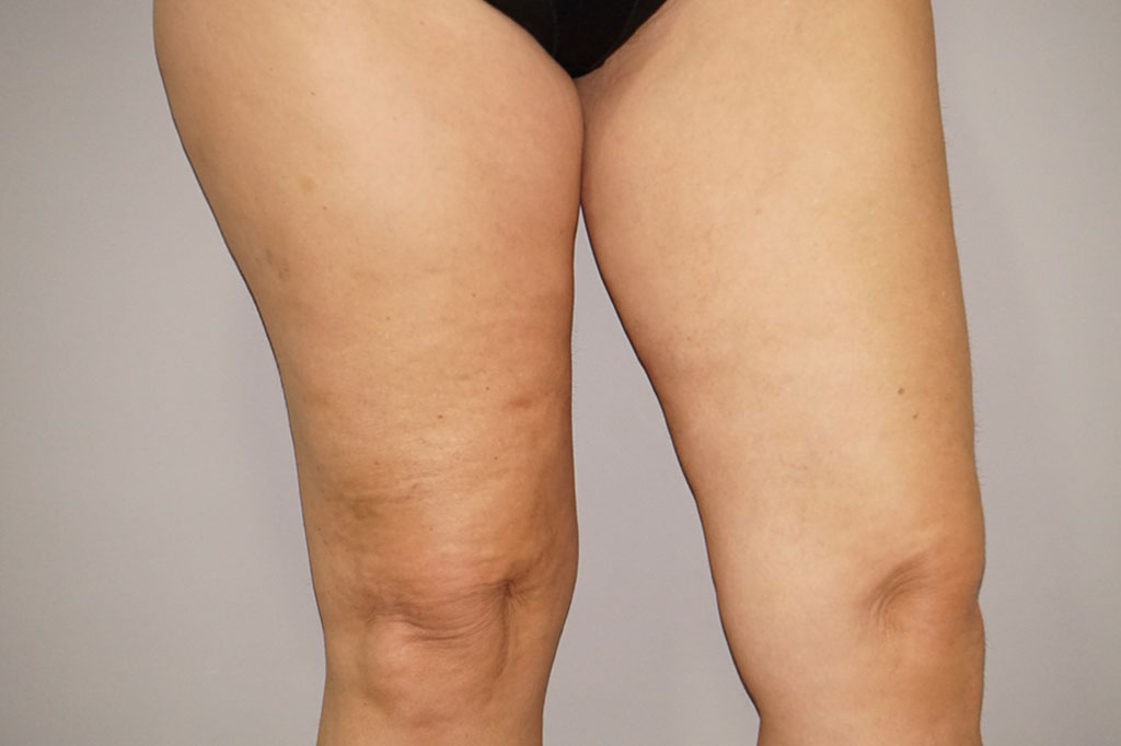 Thigh Lift  ante/post-op II