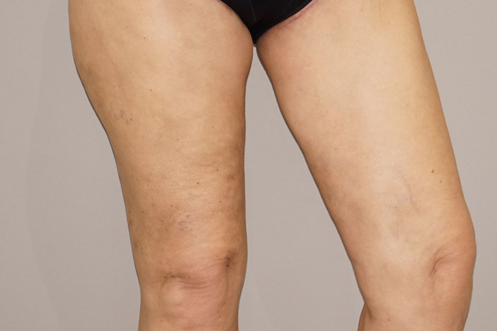 Before and after photos Thigh Lift