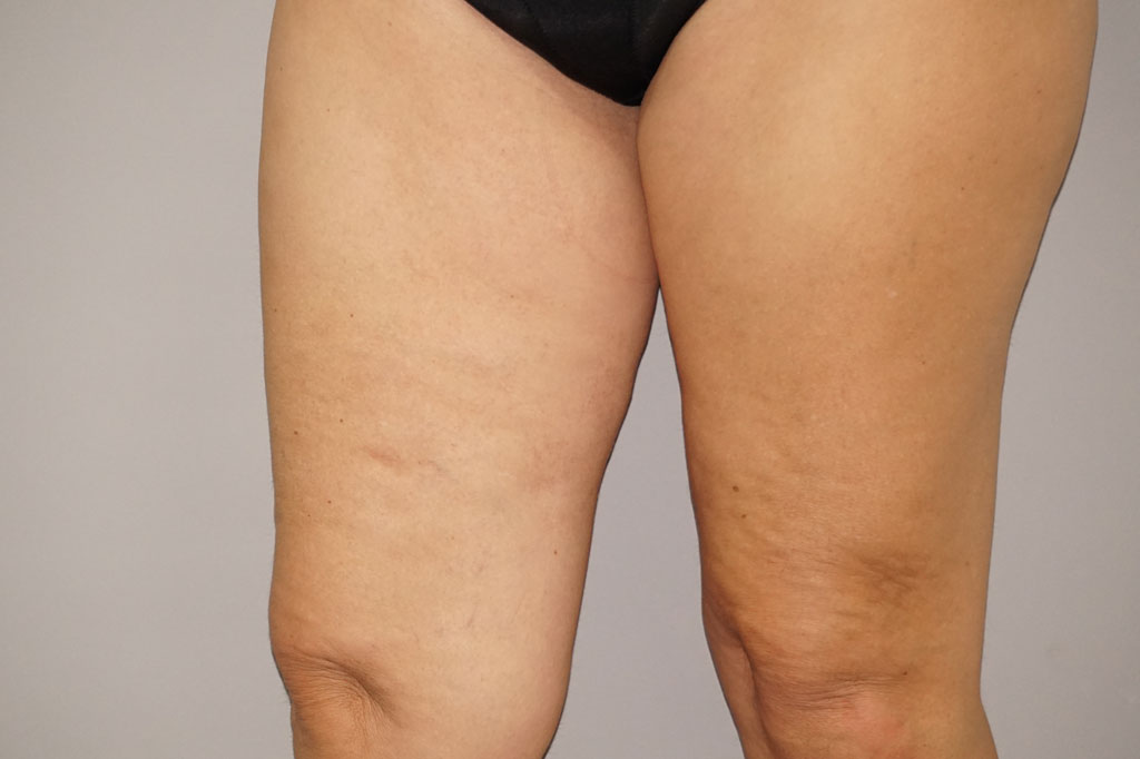 Thigh Lift  ante-op retro/lateral