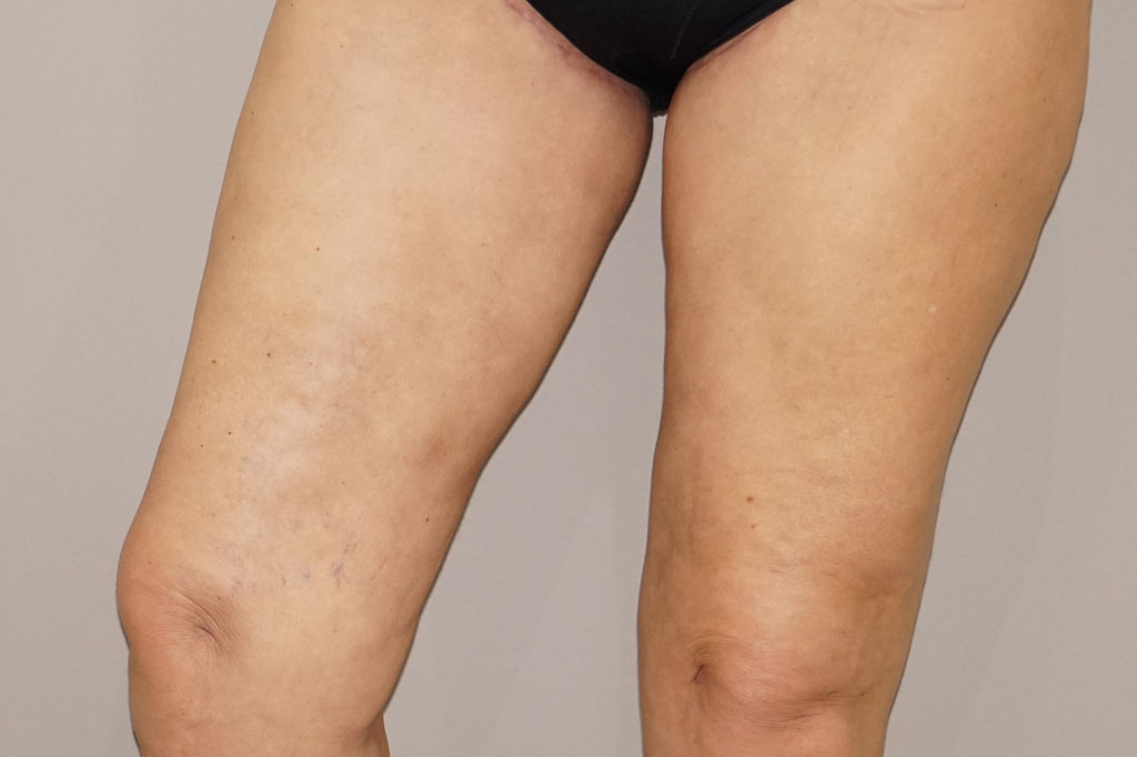 Thigh Lift  ante/post-op III