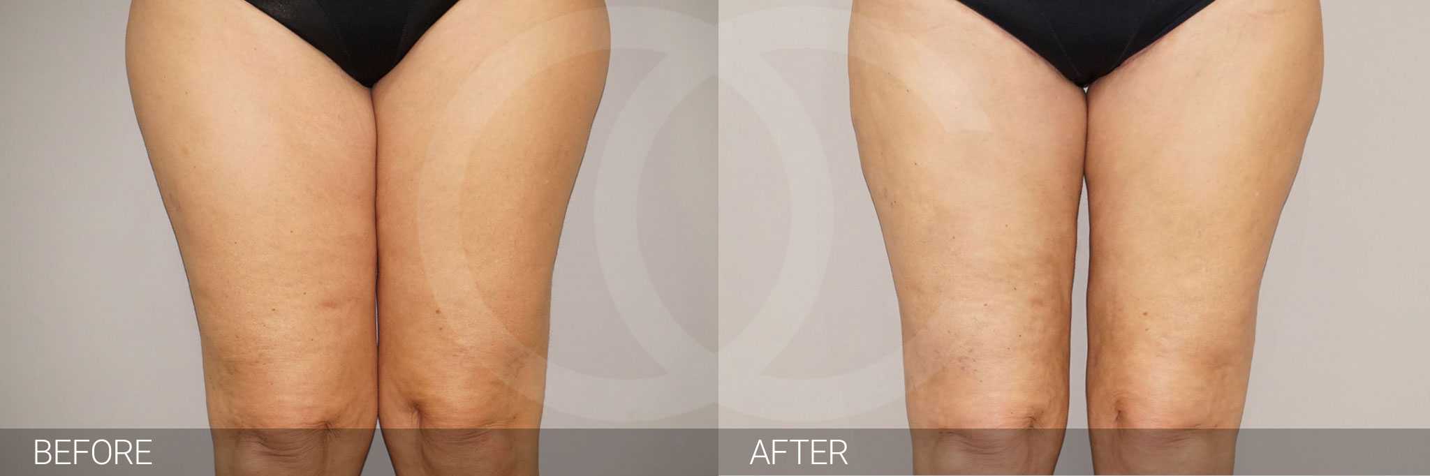 Thigh Lift  ante/post-op I