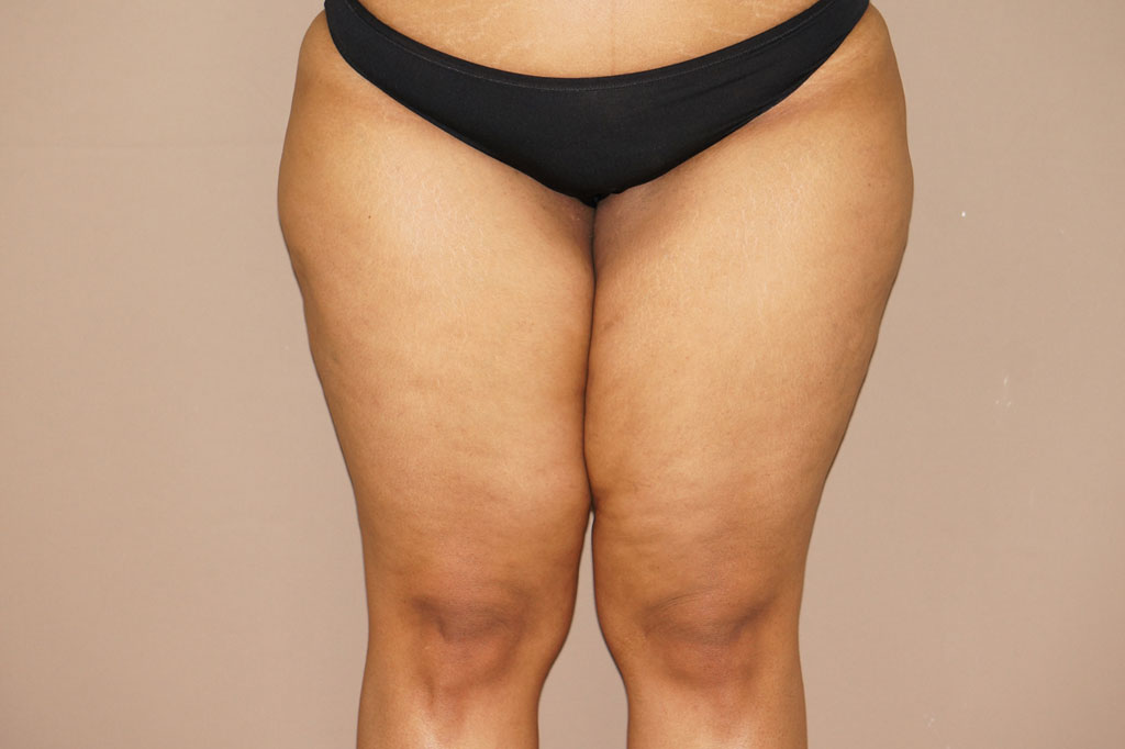 Thigh Lift  ante/post-op I