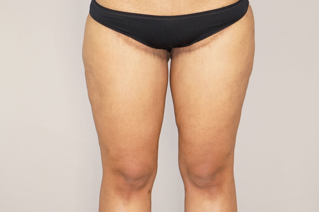 Thigh Lift  ante/post-op I