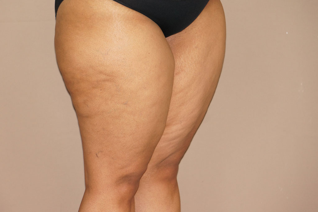 Thigh Lift  ante/post-op II