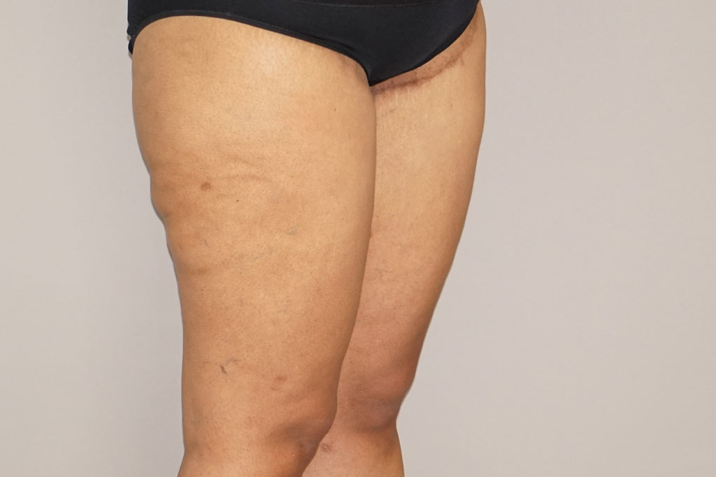 Thigh Lift  ante/post-op II