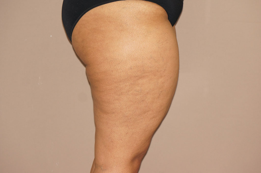 Thigh Lift  ante/post-op III