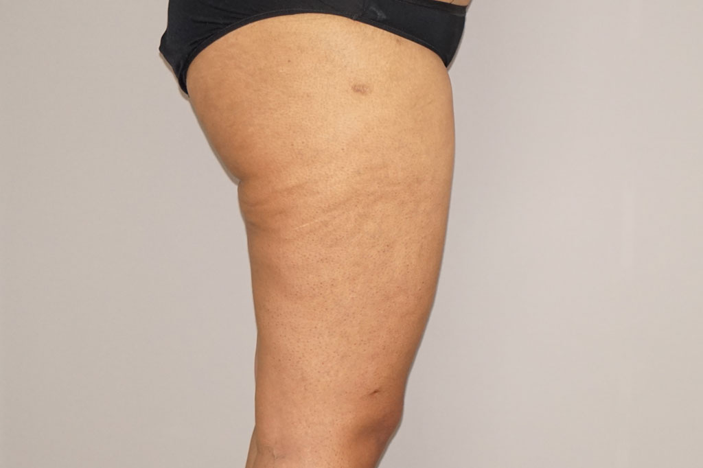 Thigh Lift  post-op retro/lateral