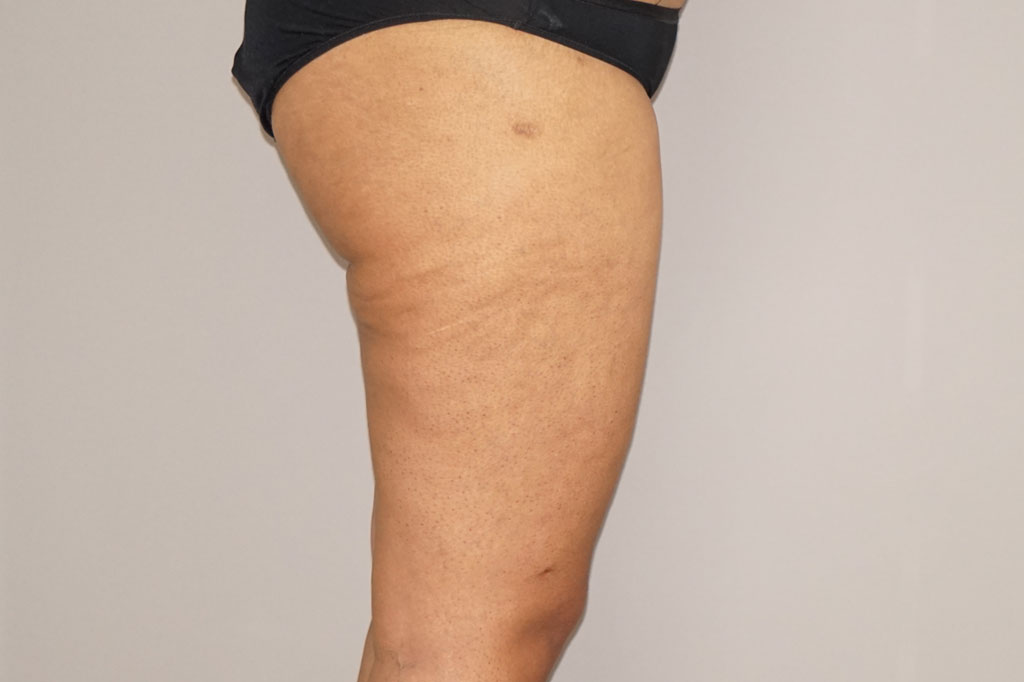 Thigh Lift  ante/post-op III