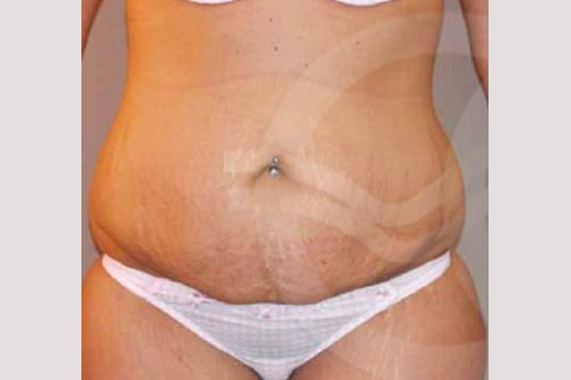 Photos Tummy Tuck  ante/post-op I