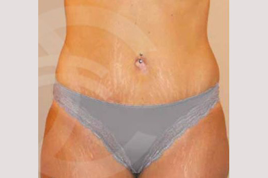 Photos Tummy Tuck  ante/post-op I
