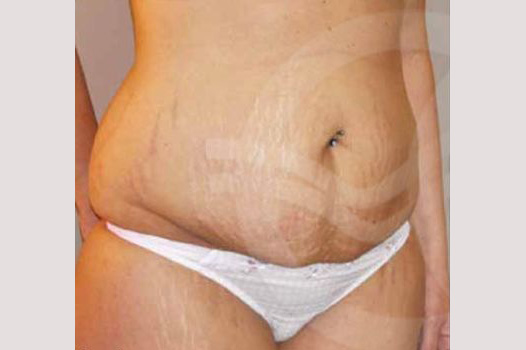 Photos Tummy Tuck  ante/post-op II