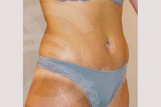 Photos Tummy Tuck  ante/post-op II