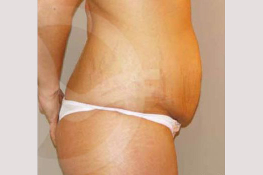Photos Tummy Tuck  ante/post-op III