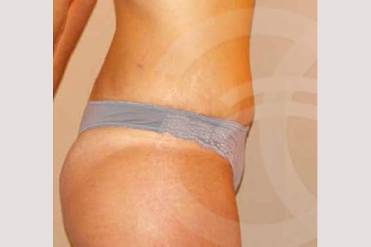 Photos Tummy Tuck  ante/post-op III