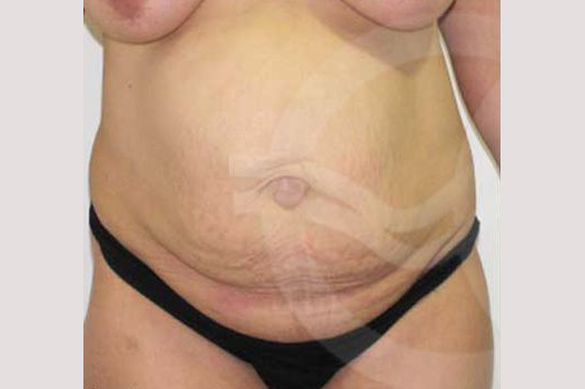 Photos Tummy Tuck  ante/post-op I