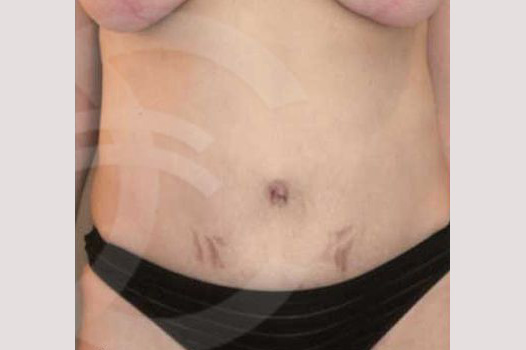 Photos Tummy Tuck  ante/post-op I