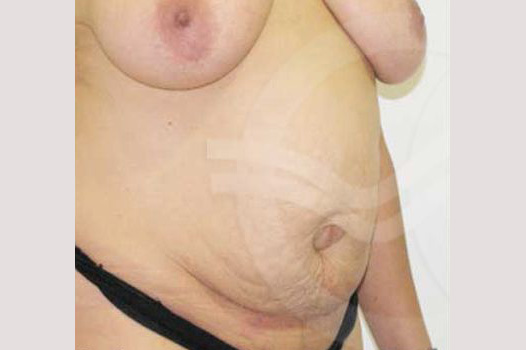 Photos Tummy Tuck  ante/post-op II