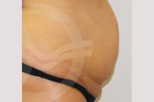 Tummy Tuck LIPOSUCTION HERNIA REPAIR ante/post-op III