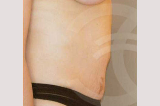 Photos Tummy Tuck  ante/post-op III