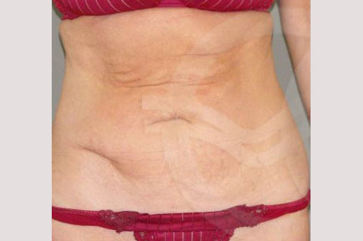 Tummy Tuck LIPOABDOMINOPLASTY SALDANHA ante/post-op I