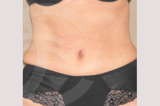 Fotos Abdominoplastia  ante/post-op I