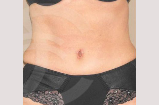 Tummy Tuck LIPOABDOMINOPLASTY SALDANHA ante/post-op I