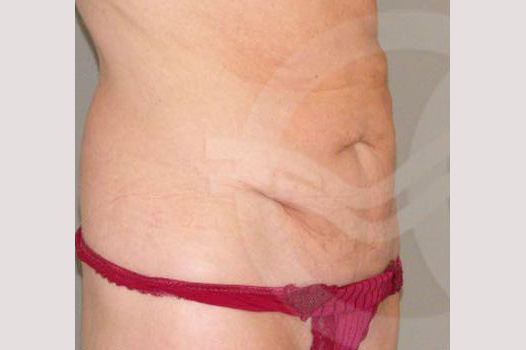 Fotos Abdominoplastia  ante/post-op II