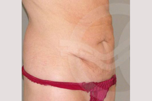 Tummy Tuck LIPOABDOMINOPLASTY SALDANHA ante/post-op II