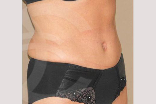 Tummy Tuck LIPOABDOMINOPLASTY SALDANHA ante/post-op II