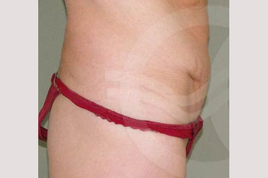 Fotos Abdominoplastia  ante/post-op III
