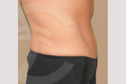 Tummy Tuck LIPOABDOMINOPLASTY SALDANHA ante/post-op III