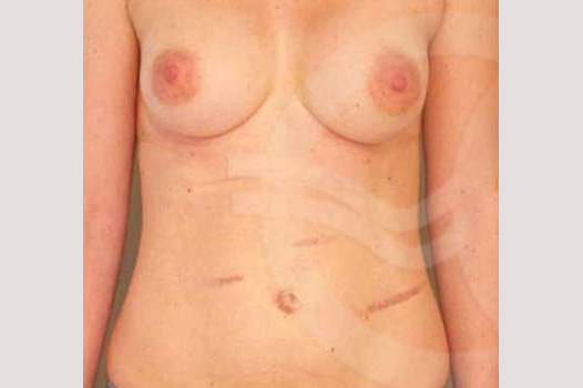 Tummy Tuck CORRECTION ABDOMINAL SCARS ante/post-op I