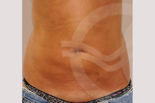 Tummy Tuck WITH LIPOSCULPTURE ante/post-op I